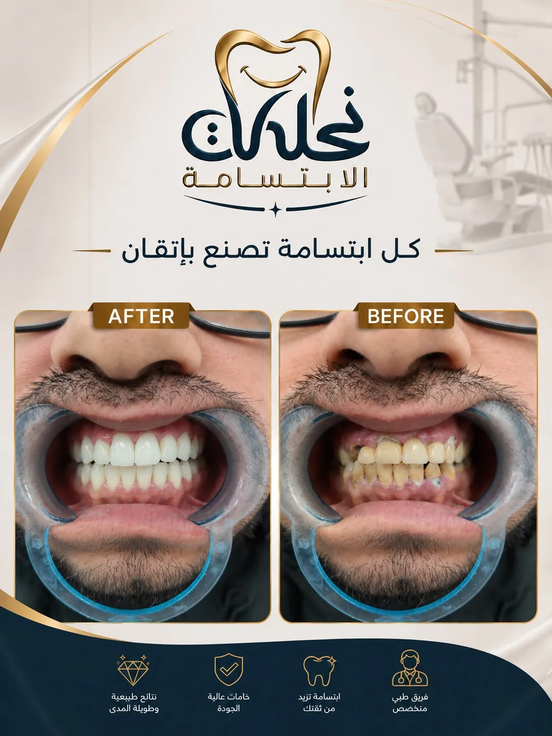 نتائج زراعة وتجميل الأسنان في نحات الابتسامة