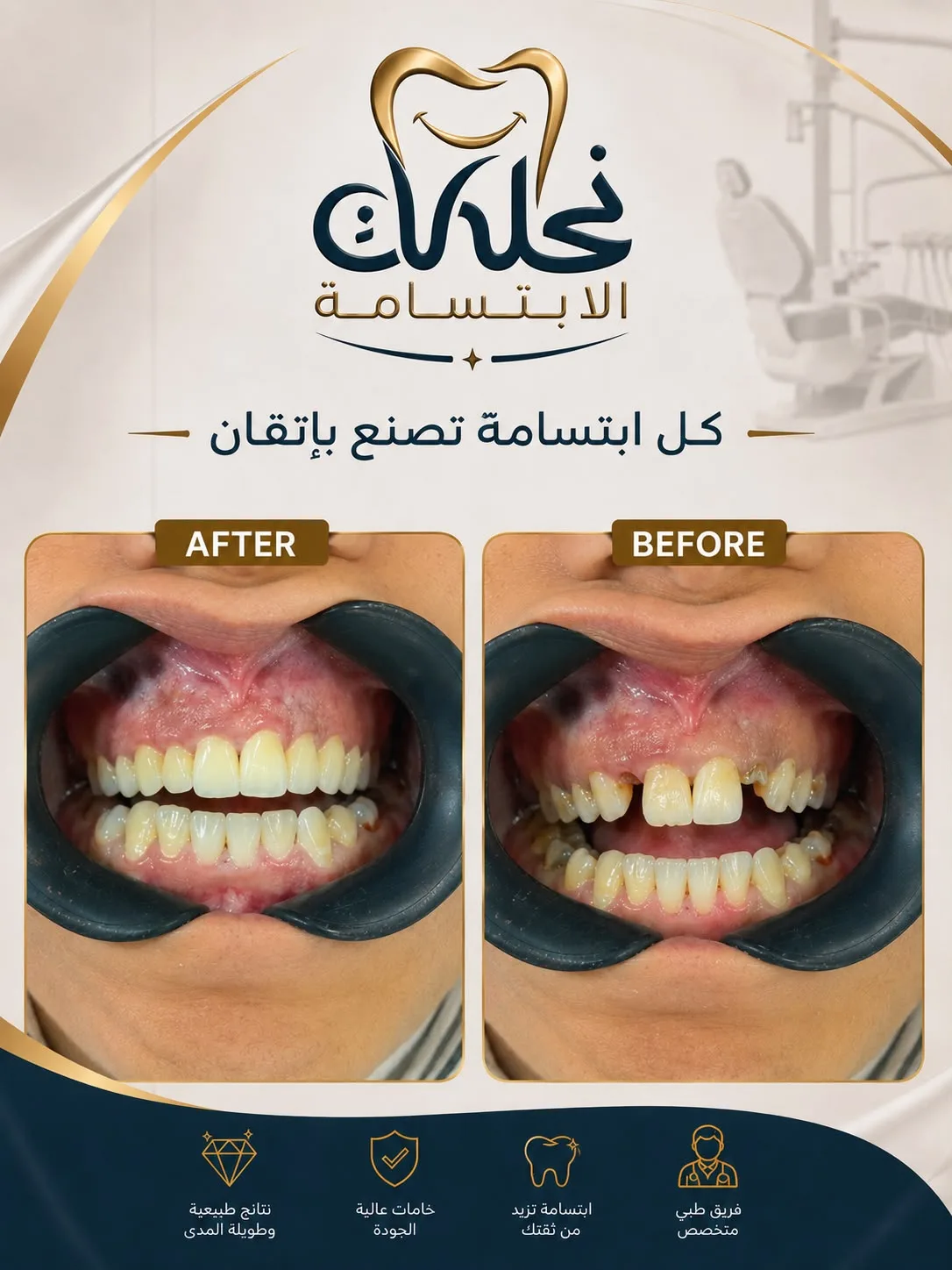 قبل وبعد ابتسامة هوليود لتعويض الأسنان المفقودة في نحات الابتسامة